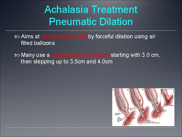 Achalasia Treatment Pneumatic Dilation Aims at disrupting the LES by forceful dilation using air