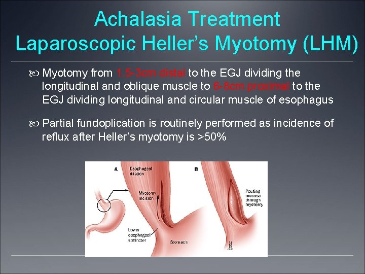 Achalasia Treatment Laparoscopic Heller’s Myotomy (LHM) Myotomy from 1. 5 -3 cm distal to