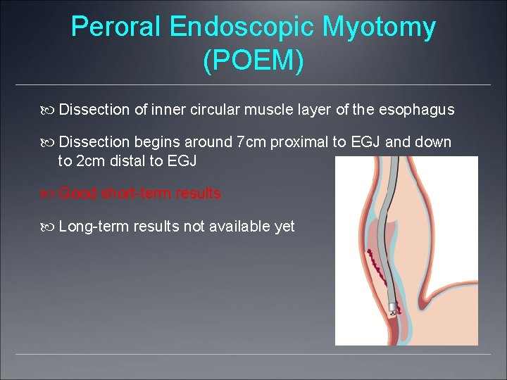 Peroral Endoscopic Myotomy (POEM) Dissection of inner circular muscle layer of the esophagus Dissection