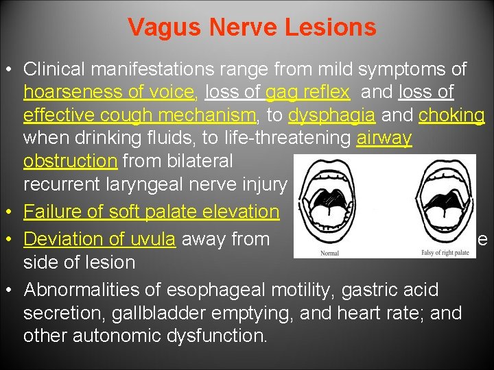 Vagus Nerve Lesions • Clinical manifestations range from mild symptoms of hoarseness of voice,