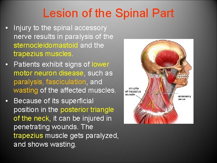 Lesion of the Spinal Part • Injury to the spinal accessory nerve results in