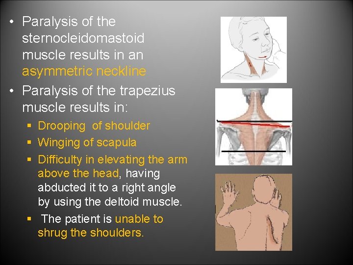  • Paralysis of the sternocleidomastoid muscle results in an asymmetric neckline • Paralysis