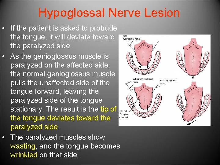 Hypoglossal Nerve Lesion • If the patient is asked to protrude the tongue, it