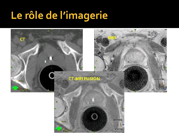 Le rôle de l’imagerie MRI CT CT-MRI FUSION 