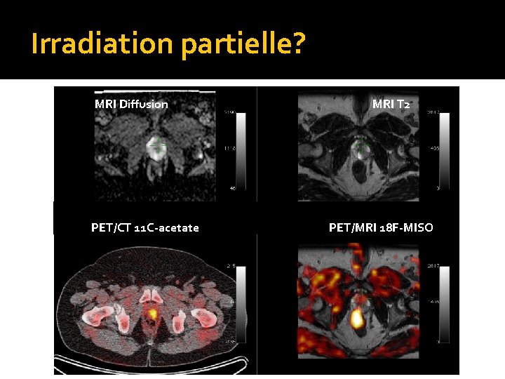 Irradiation partielle? MRI Diffusion PET/CT 11 C-acetate MRI T 2 PET/MRI 18 F-MISO 