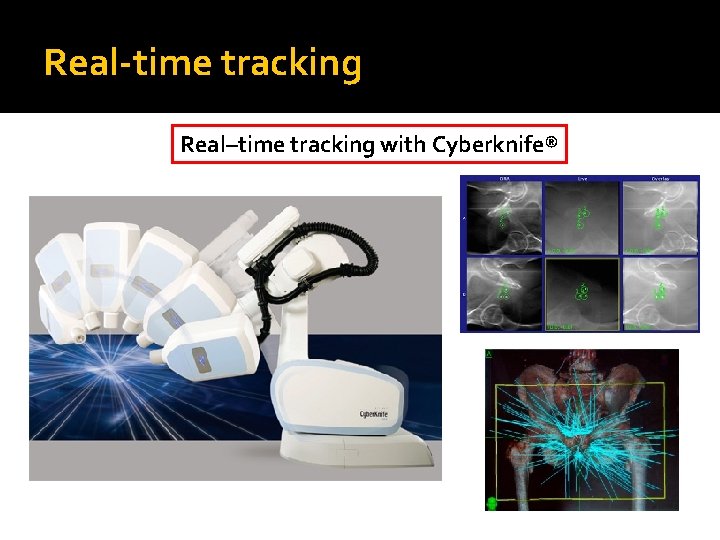 Real-time tracking Real–time tracking with Cyberknife® 