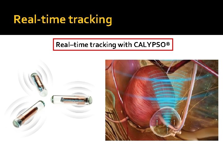 Real-time tracking Real–time tracking with CALYPSO® Flexi. Mark G/T Civco® (used in GVA) Poly.