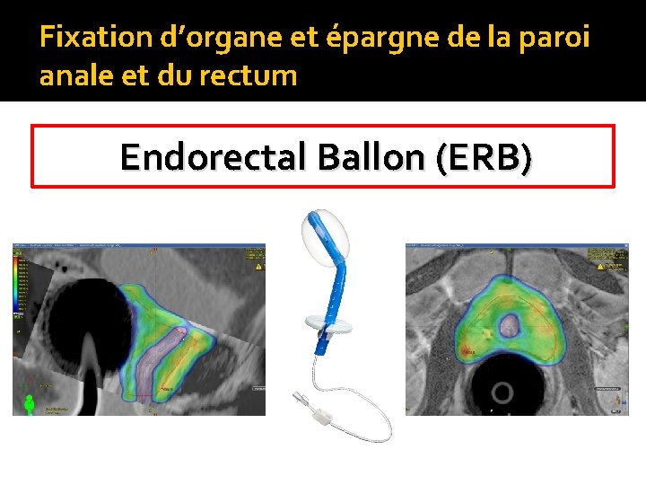 Fixation d’organe et épargne de la paroi anale et du rectum Endorectal Ballon (ERB)
