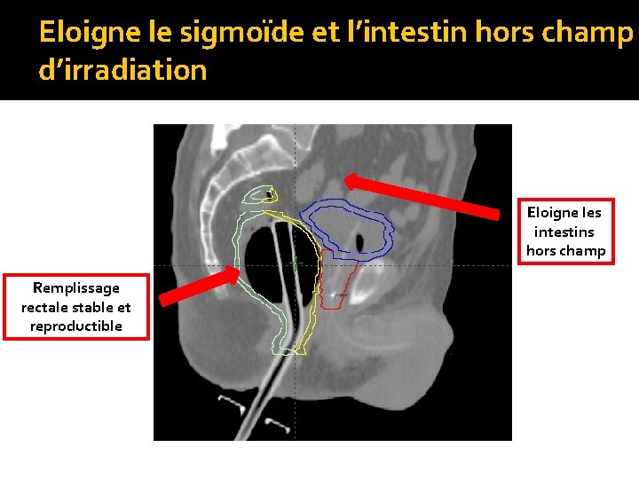 Eloigne le sigmoïde et l’intestin hors champ d’irradiation Eloigne les intestins hors champ Remplissage