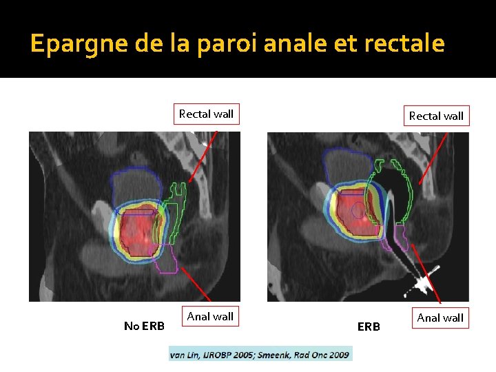 Epargne de la paroi anale et rectale No ERB Rectal wall Anal wall ERB