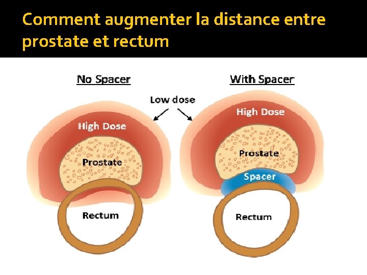 Comment augmenter la distance entre prostate et rectum 