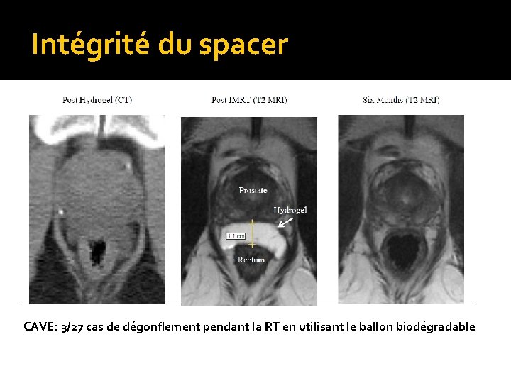 Intégrité du spacer CAVE: 3/27 cas de dégonflement pendant la RT en utilisant le