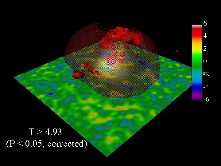 T>4. 86 T > 4. 93 (P < 0. 05, corrected) 