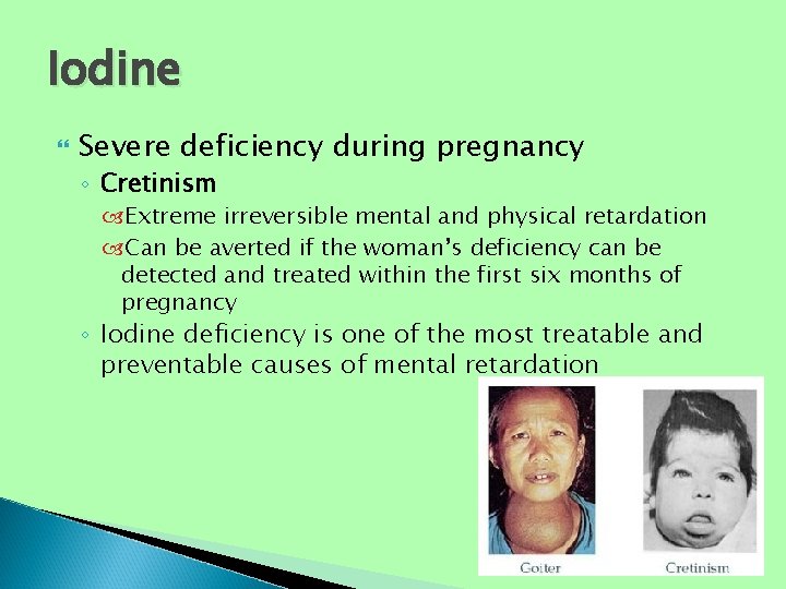 Iodine Severe deficiency during pregnancy ◦ Cretinism Extreme irreversible mental and physical retardation Can Iodine Severe deficiency during pregnancy ◦ Cretinism Extreme irreversible mental and physical retardation Can