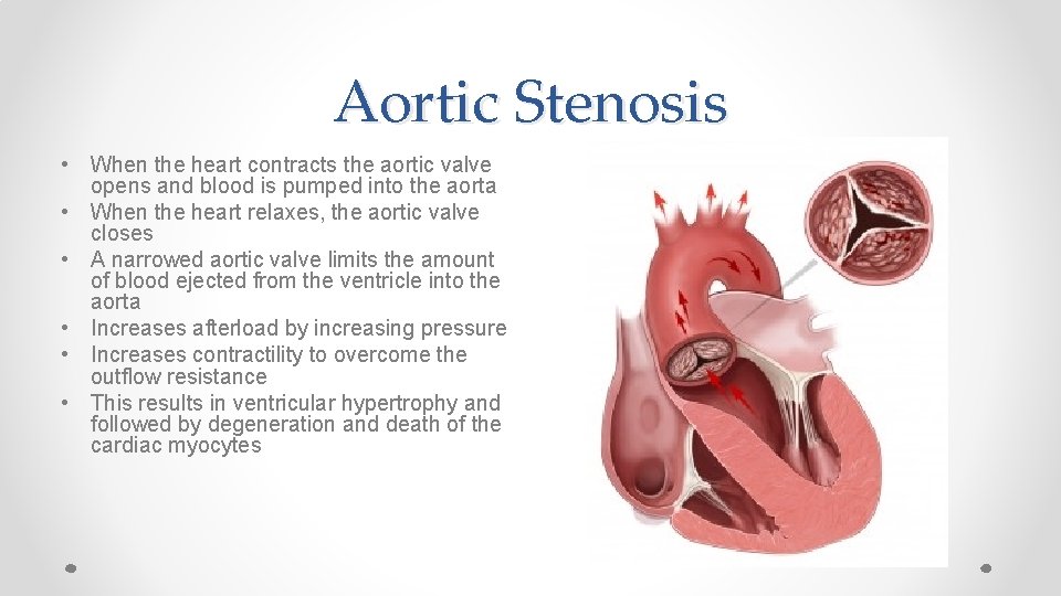 Aortic Stenosis • When the heart contracts the aortic valve opens and blood is