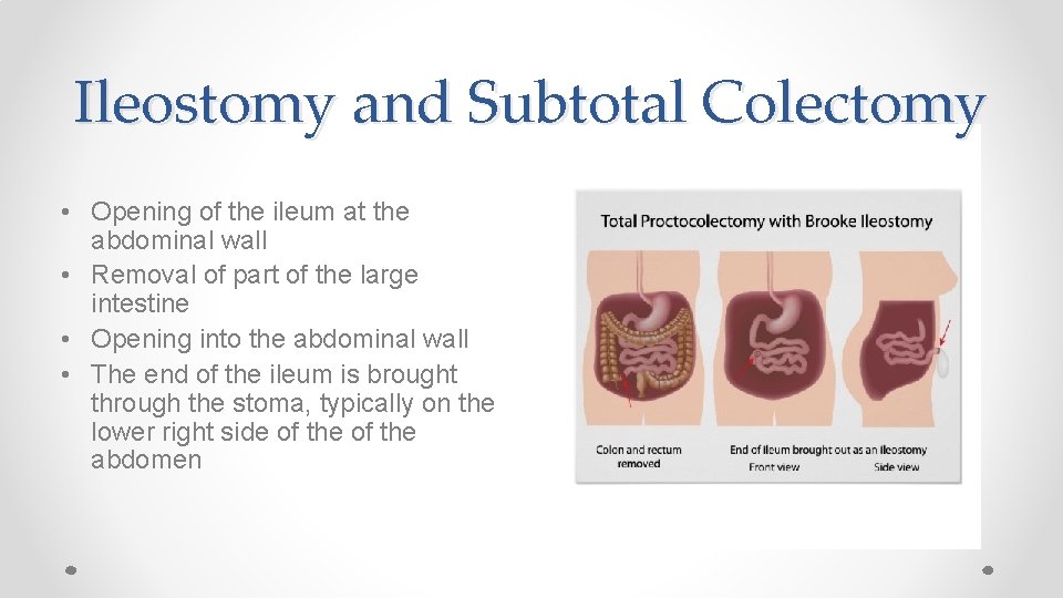 Ileostomy and Subtotal Colectomy • Opening of the ileum at the abdominal wall •