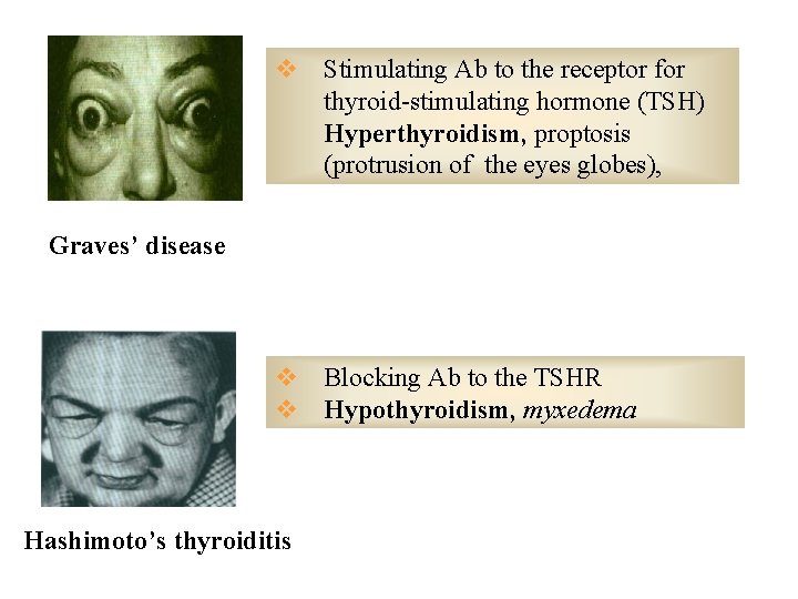 v Stimulating Ab to the receptor for thyroid-stimulating hormone (TSH) Hyperthyroidism, proptosis (protrusion of