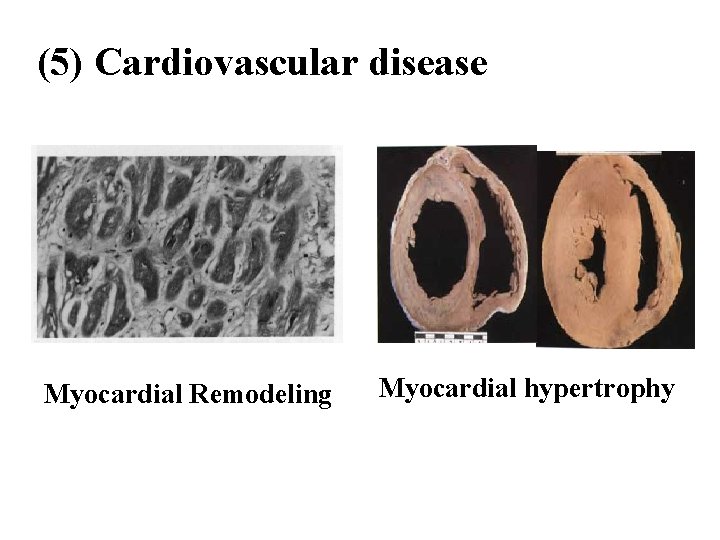 (5) Cardiovascular disease Myocardial Remodeling Myocardial hypertrophy 