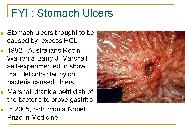 FYI : Stomach Ulcers n n Stomach ulcers thought to be caused by excess FYI : Stomach Ulcers n n Stomach ulcers thought to be caused by excess
