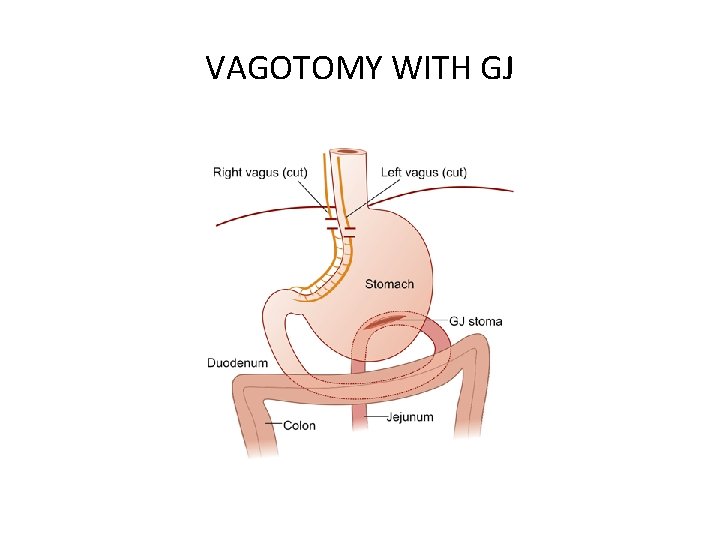 VAGOTOMY WITH GJ 