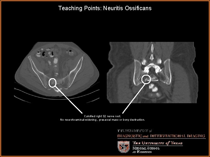 Teaching Points: Neuritis Ossificans Calcified right S 2 nerve root. No neuroforaminal widening ,