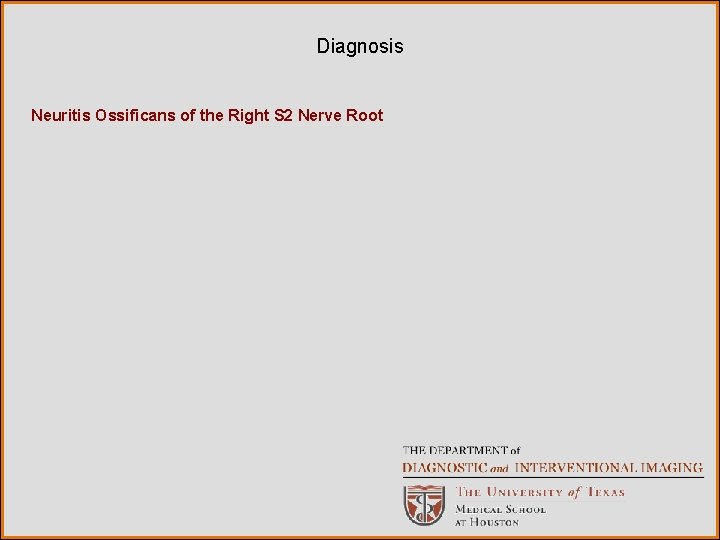 Diagnosis Neuritis Ossificans of the Right S 2 Nerve Root 