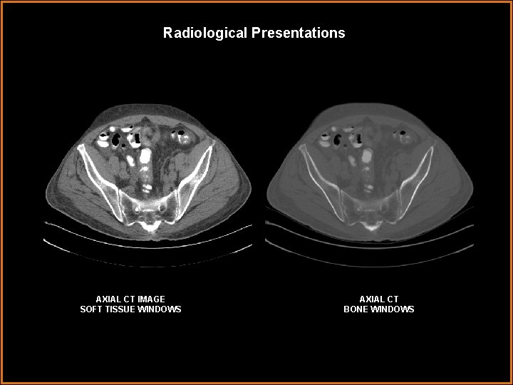 Radiological Presentations AXIAL CT IMAGE SOFT TISSUE WINDOWS AXIAL CT BONE WINDOWS 