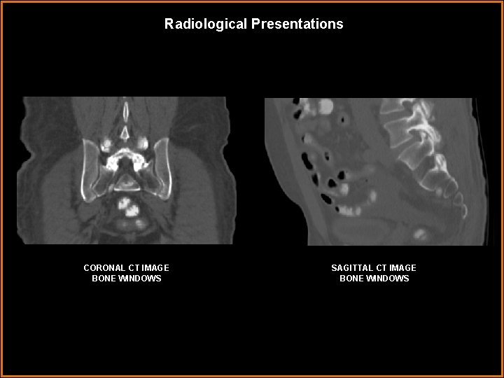 Radiological Presentations CORONAL CT IMAGE BONE WINDOWS SAGITTAL CT IMAGE BONE WINDOWS 