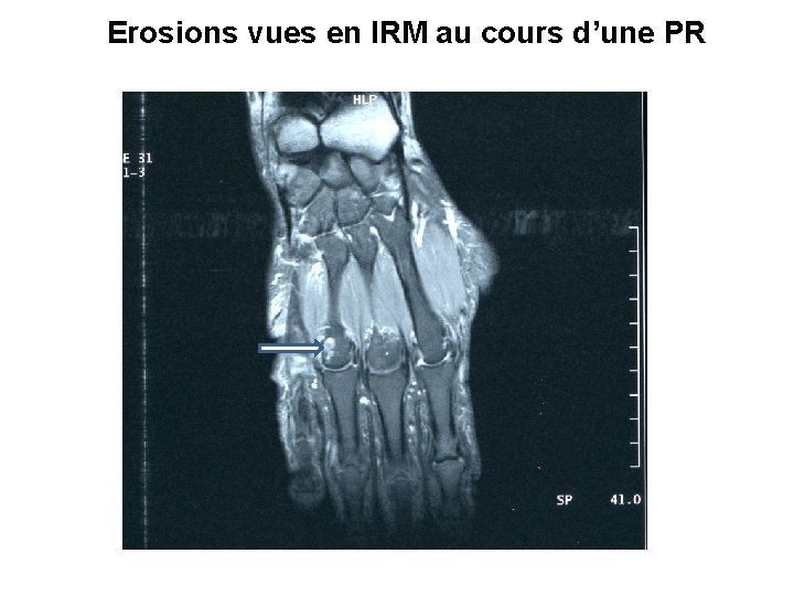 Erosions vues en IRM au cours d’une PR 