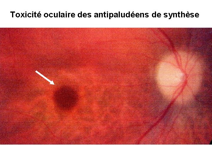 Toxicité oculaire des antipaludéens de synthèse 