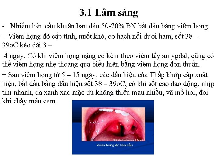 3. 1 Lâm sàng - Nhiễm liên cầu khuẩn ban đầu 50 -70% BN