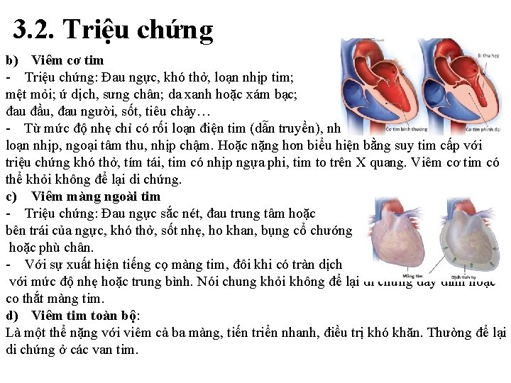 3. 2. Triệu chứng b) Viêm cơ tim - Triệu chứng: Đau ngực, khó