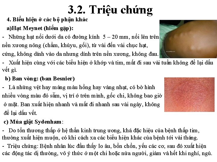 3. 2. Triệu chứng 4. Biểu hiện ở các bộ phận khác a)Hạt Meynet