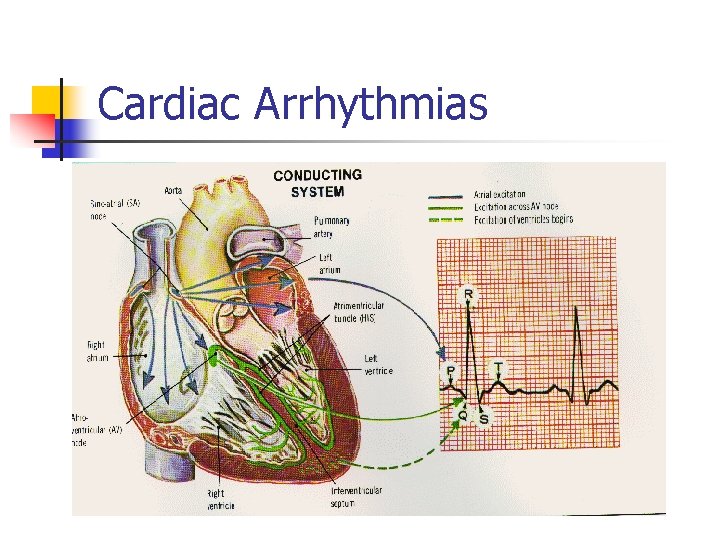Cardiac Arrhythmias 