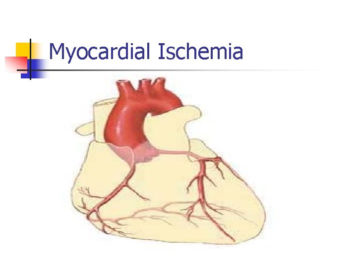 Myocardial Ischemia 