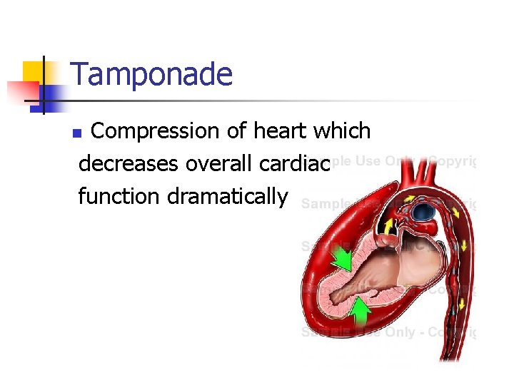 Tamponade Compression of heart which decreases overall cardiac function dramatically n 