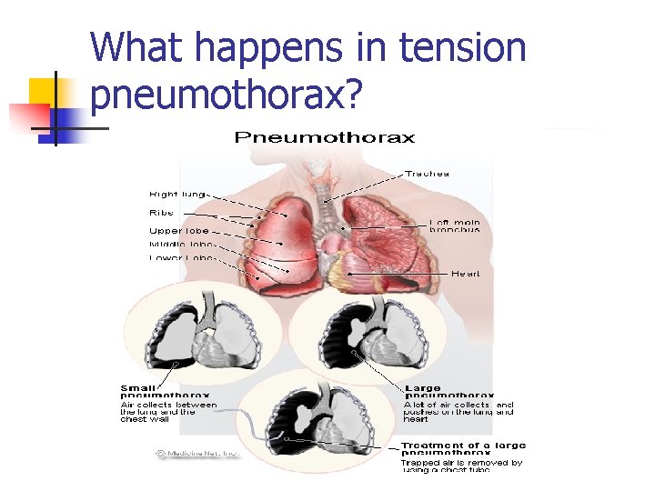 What happens in tension pneumothorax? 