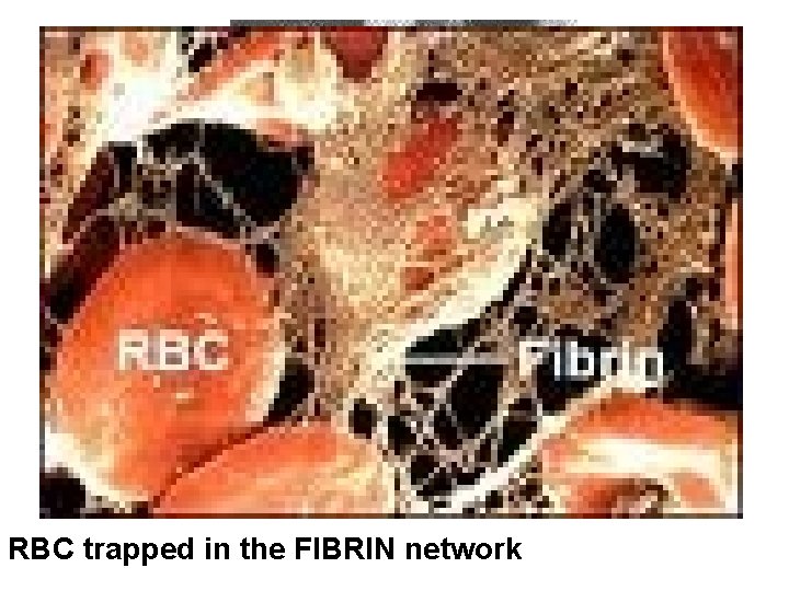 RBC trapped in the FIBRIN network 