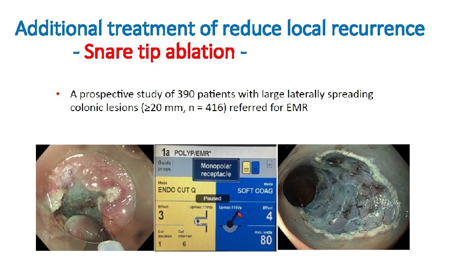 Additional treatment of reduce local recurrence - Snare tip ablation - 