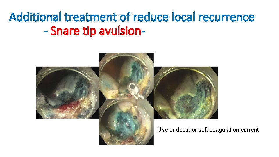 Additional treatment of reduce local recurrence - Snare tip avulsion- Use endocut or soft