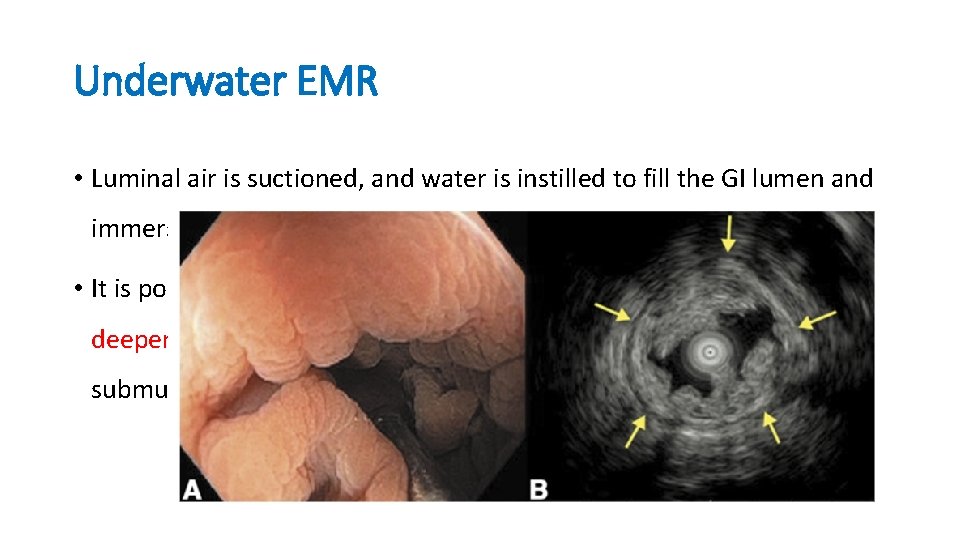Underwater EMR • Luminal air is suctioned, and water is instilled to fill the