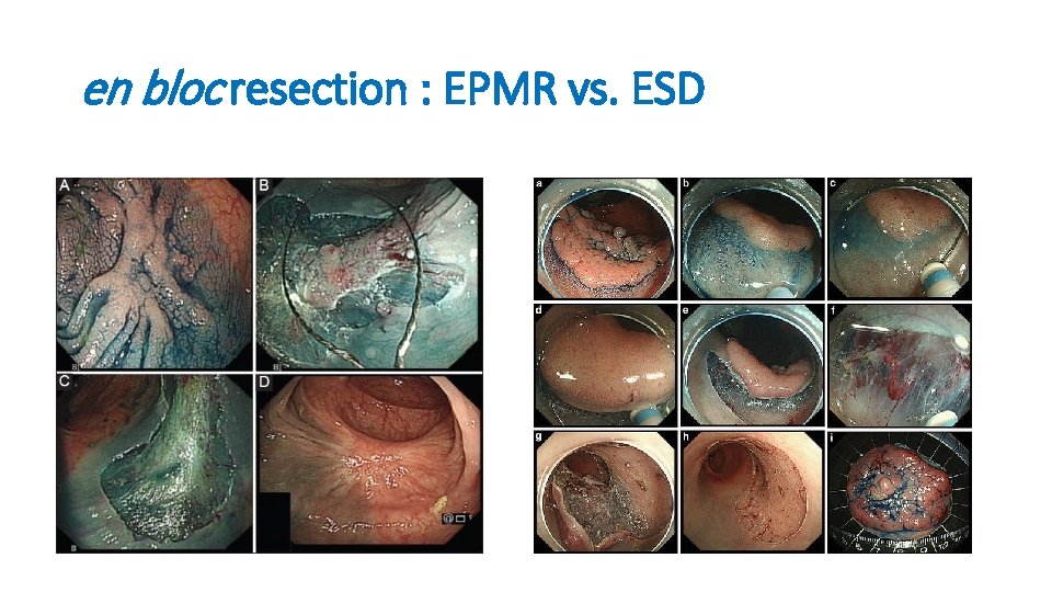 en bloc resection : EPMR vs. ESD 