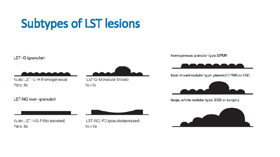 Subtypes of LST lesions 