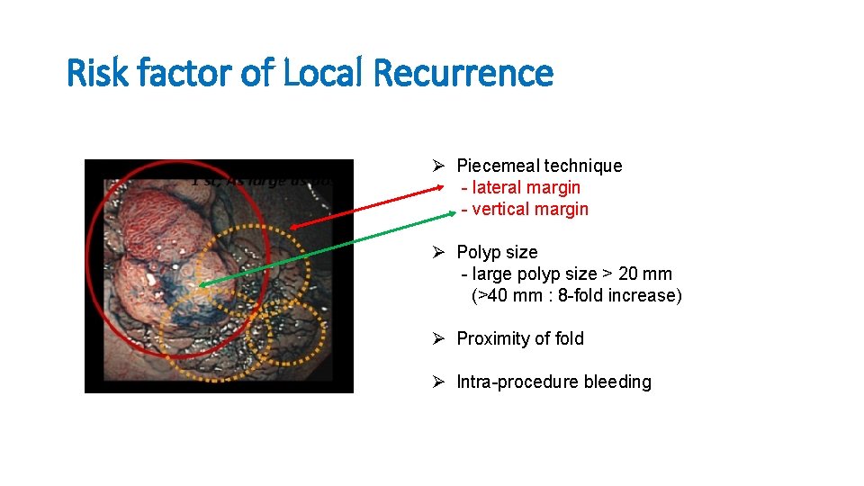 Risk factor of Local Recurrence Ø Piecemeal technique - lateral margin - vertical margin