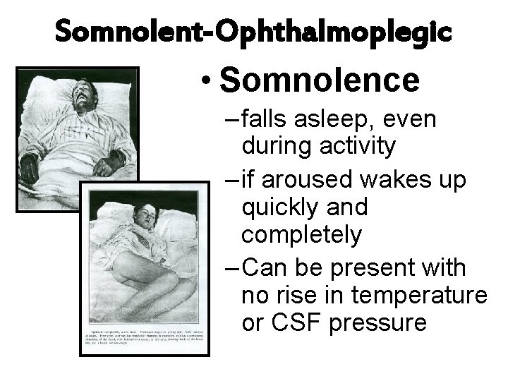 Somnolent-Ophthalmoplegic • Somnolence – falls asleep, even during activity – if aroused wakes up