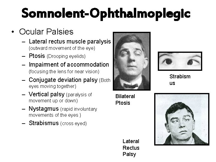 Somnolent-Ophthalmoplegic • Ocular Palsies – Lateral rectus muscle paralysis (outward movement of the eye)