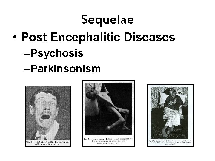 Sequelae • Post Encephalitic Diseases – Psychosis – Parkinsonism 