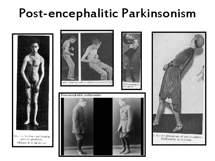Post-encephalitic Parkinsonism 
