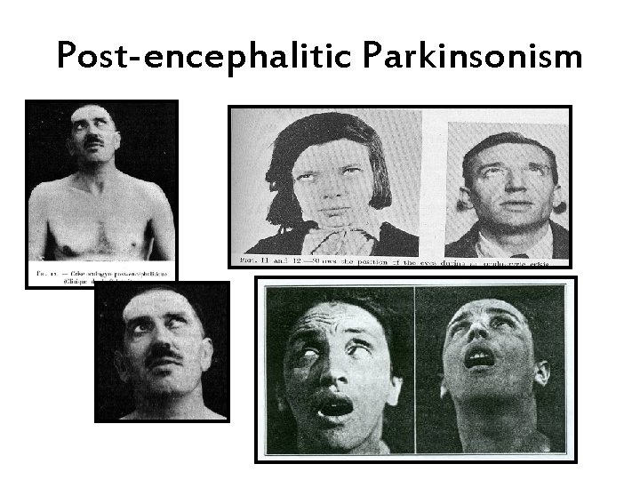 Post-encephalitic Parkinsonism 