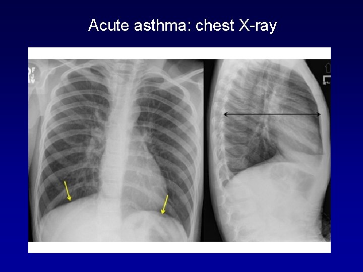 Acute asthma: chest X-ray 